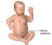 Hernias umbilicales en bebés y niños